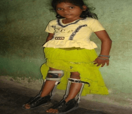Orthopedic Shoes For Shakthi Bala