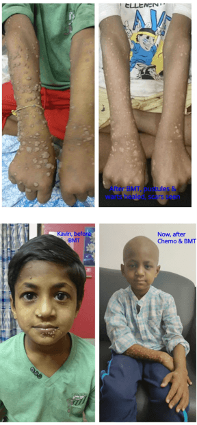 SUPPORTING FOR BONE MARROW TRANSPLANTATION (BMT) SURGERY